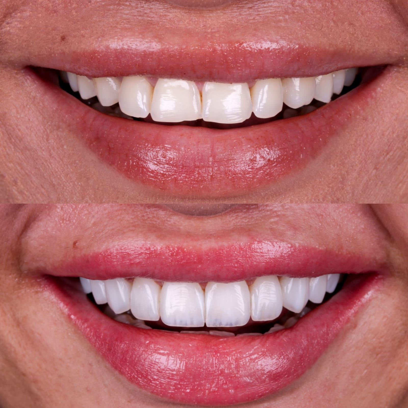 Antes e depois de facetas em porcelana